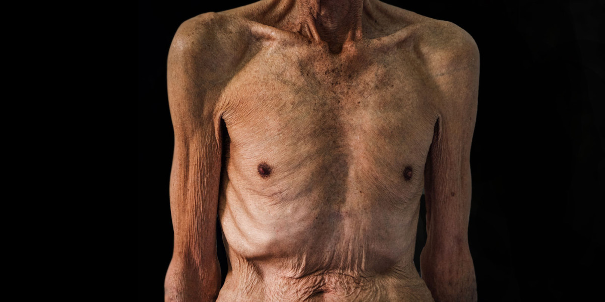 Sterbefasten. Wenn Senioren Essen und Trinken verweigern