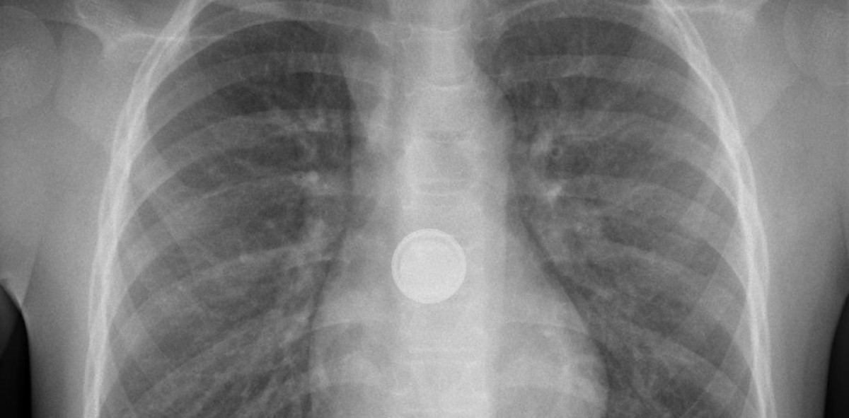 Batterien konsequent ausserhalb der Reichweite von Kindern aufbewahren